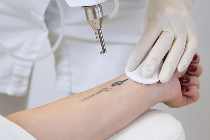 Epilation et détatouage Séance de détatouage